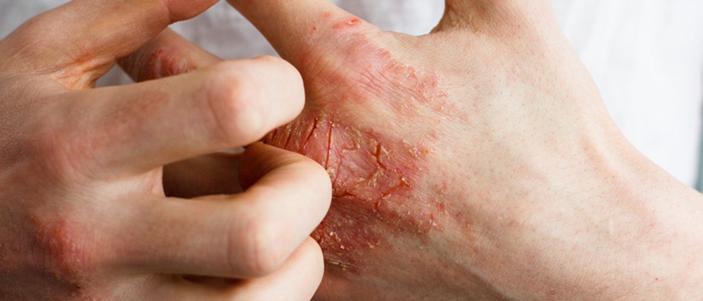 mains qui grattent avec eczema